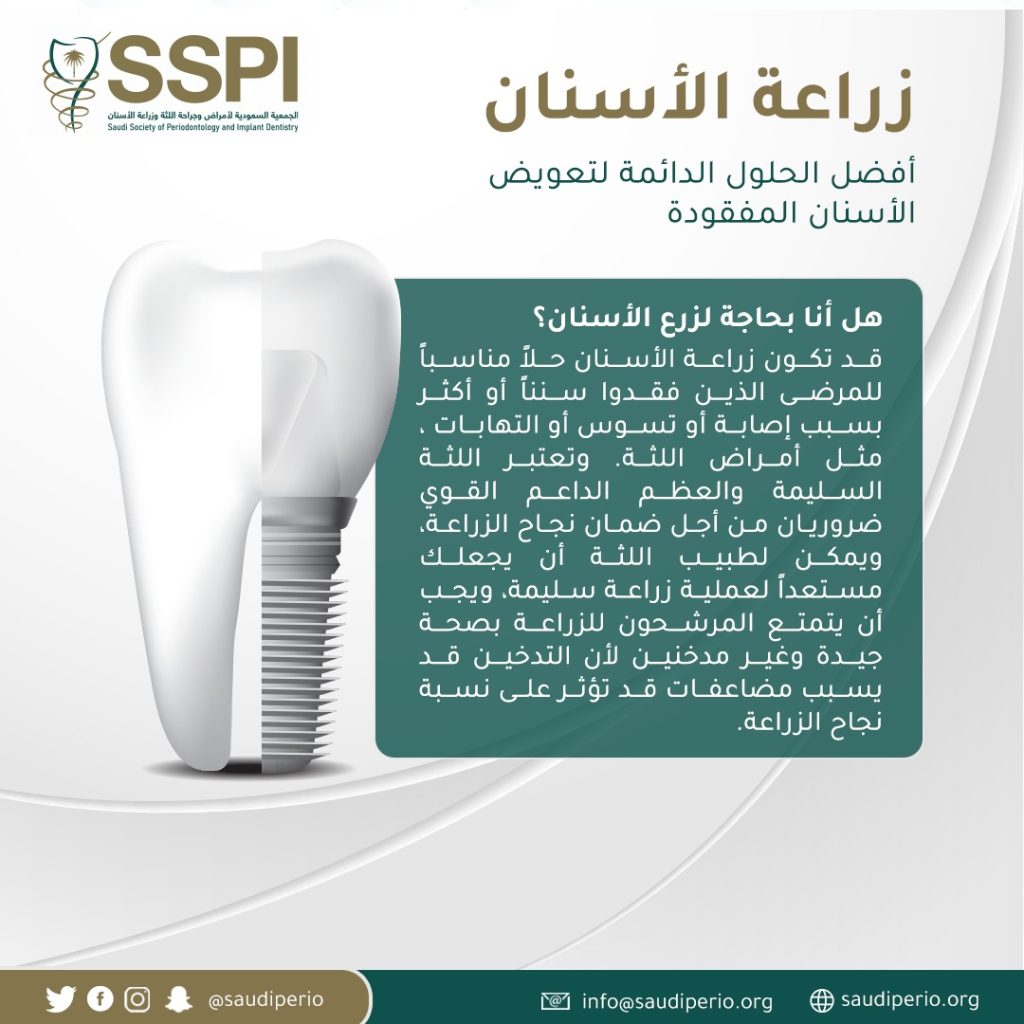 Dental implants